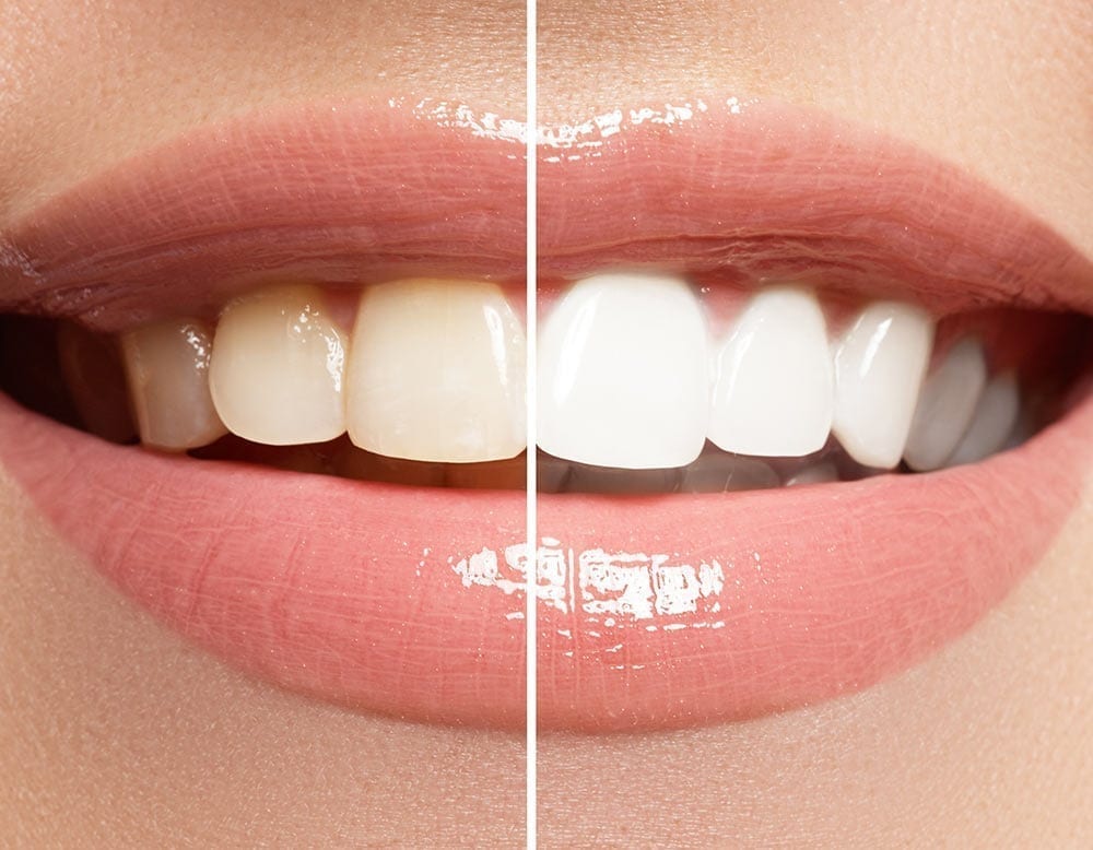 Before and After Teeth Whitening