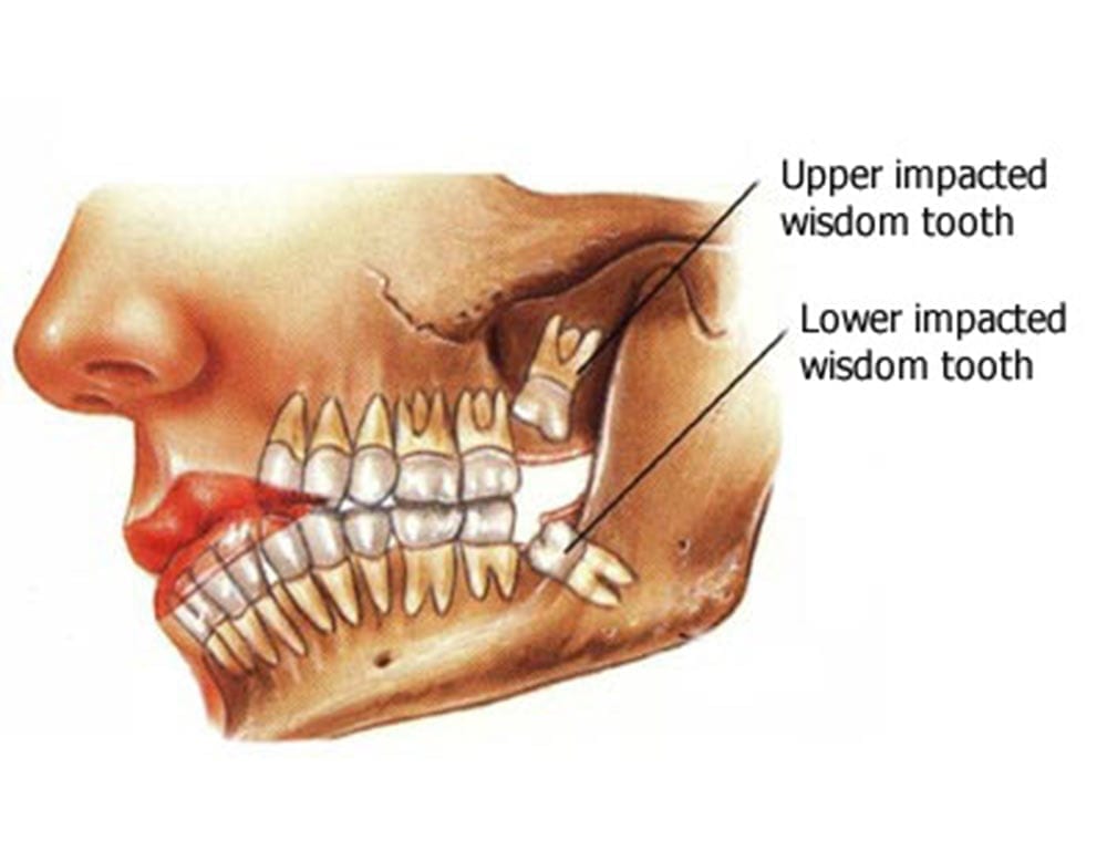 Diagram of Upper Impacted Wisdom Tooth and Lower Impacted Wisdom Tooth