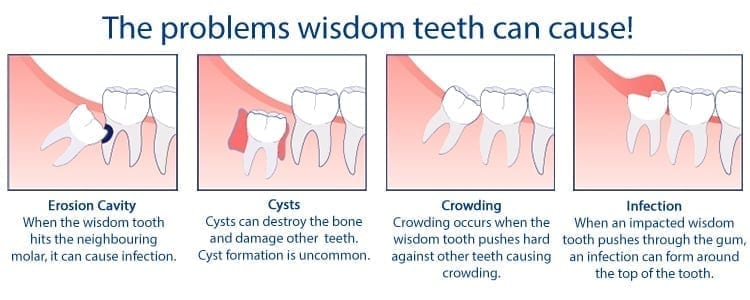 Problems wisdom teeth can cause infographic
