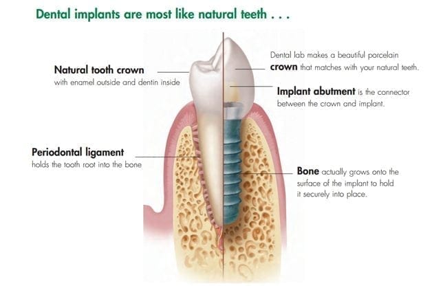 Dental implants are most like natural teeth infographic