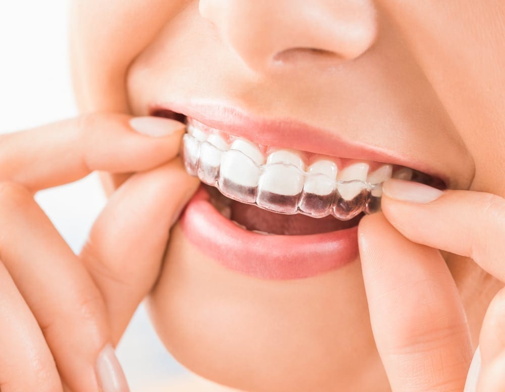 Woman Putting on a Clear Dental Retainer