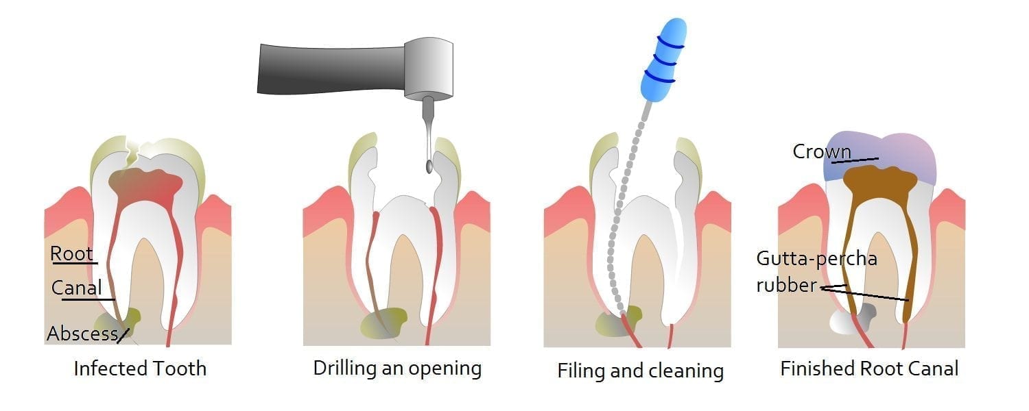 root canal infographic