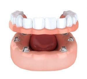 shutterstock_482112418 Implants Retained Dentures