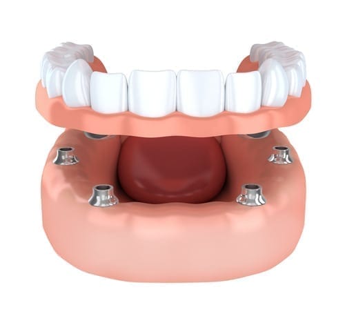 Implants Retained Dentures