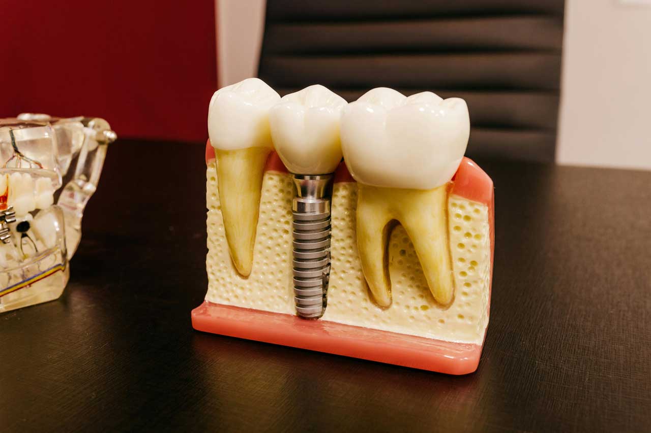 Dental-Implant